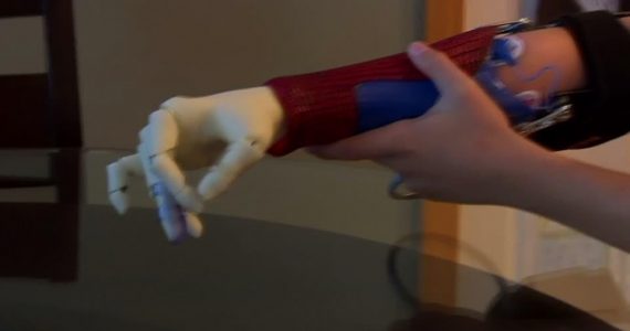 Prosthetic arm helps 10-year-old feel like a superhero